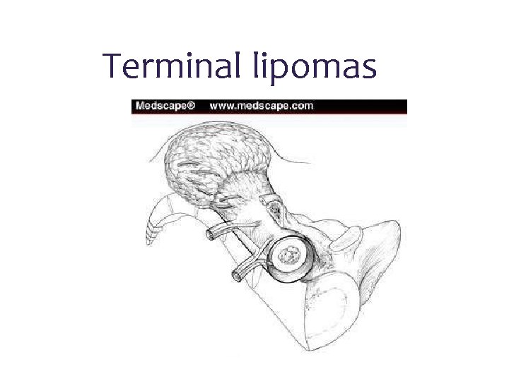 Terminal lipomas 