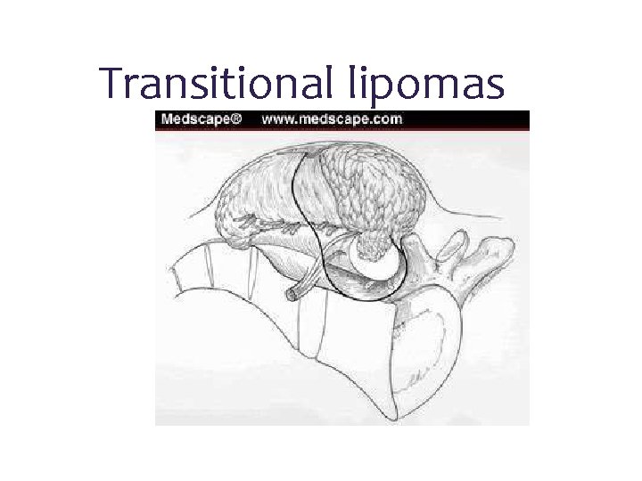 Transitional lipomas 