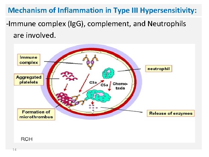 Mechanism of Inflammation in Type III Hypersensitivity: -Immune complex (Ig. G), complement, and Neutrophils