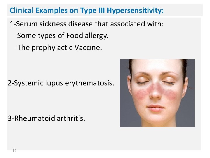 Clinical Examples on Type III Hypersensitivity: 1 -Serum sickness disease that associated with: -Some