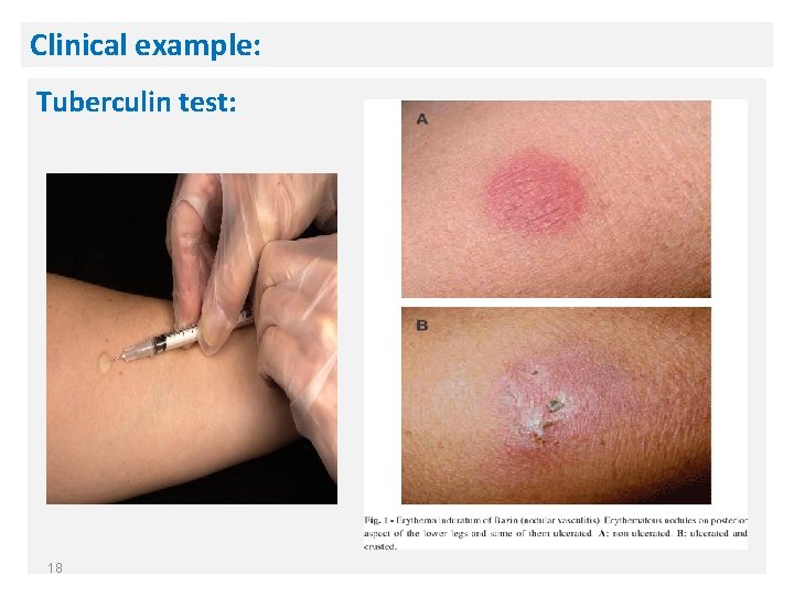 Clinical example: Tuberculin test: 18 