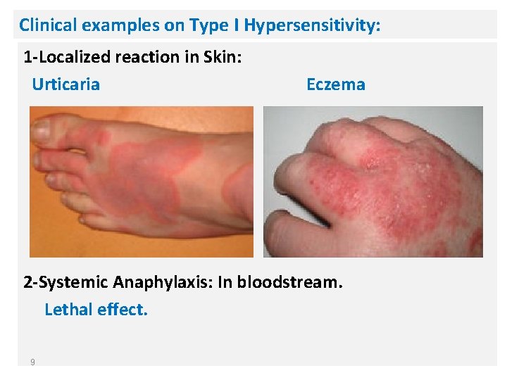 Clinical examples on Type I Hypersensitivity: 1 -Localized reaction in Skin: Urticaria Eczema 2