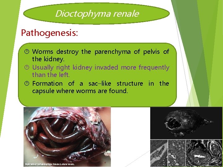 Dioctophyma renale Pathogenesis: Worms destroy the parenchyma of pelvis of the kidney. Usually right