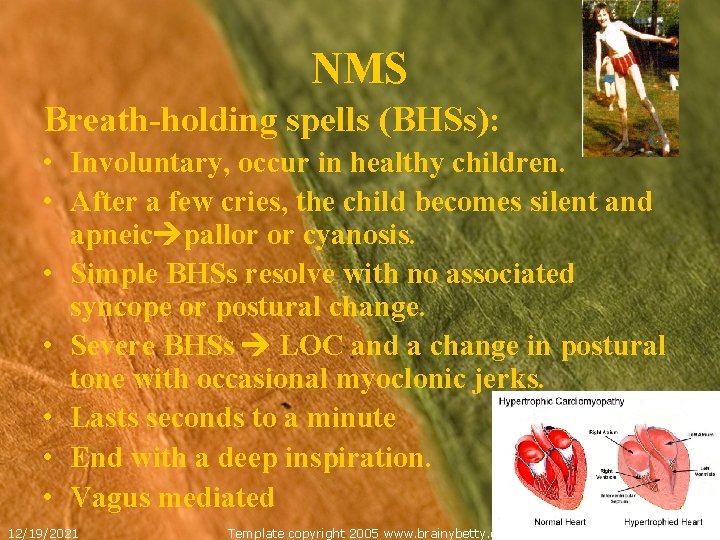 NMS Breath-holding spells (BHSs): • Involuntary, occur in healthy children. • After a few