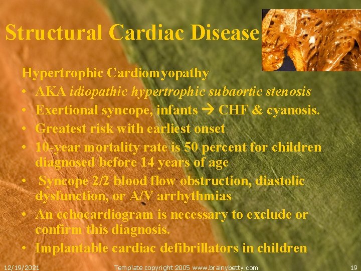 Structural Cardiac Disease Hypertrophic Cardiomyopathy • AKA idiopathic hypertrophic subaortic stenosis • Exertional syncope,