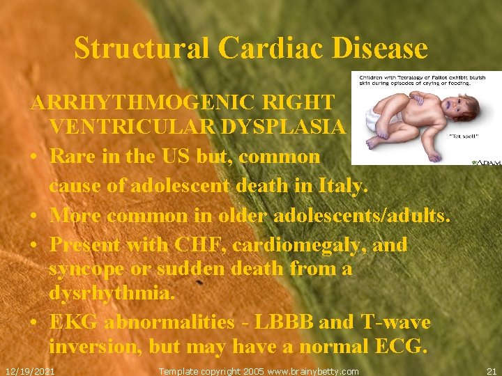 Structural Cardiac Disease ARRHYTHMOGENIC RIGHT VENTRICULAR DYSPLASIA • Rare in the US but, common