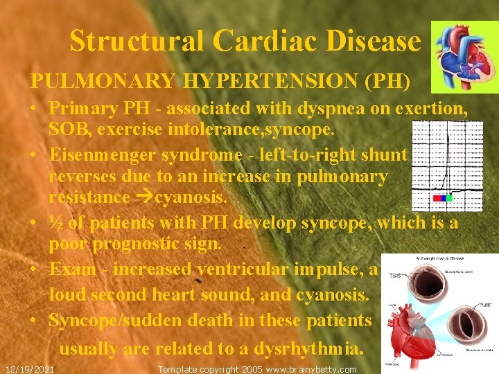 Structural Cardiac Disease PULMONARY HYPERTENSION (PH) • Primary PH - associated with dyspnea on