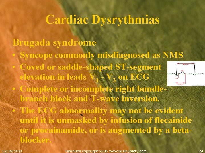 Cardiac Dysrythmias Brugada syndrome • Syncope commonly misdiagnosed as NMS • Coved or saddle-shaped