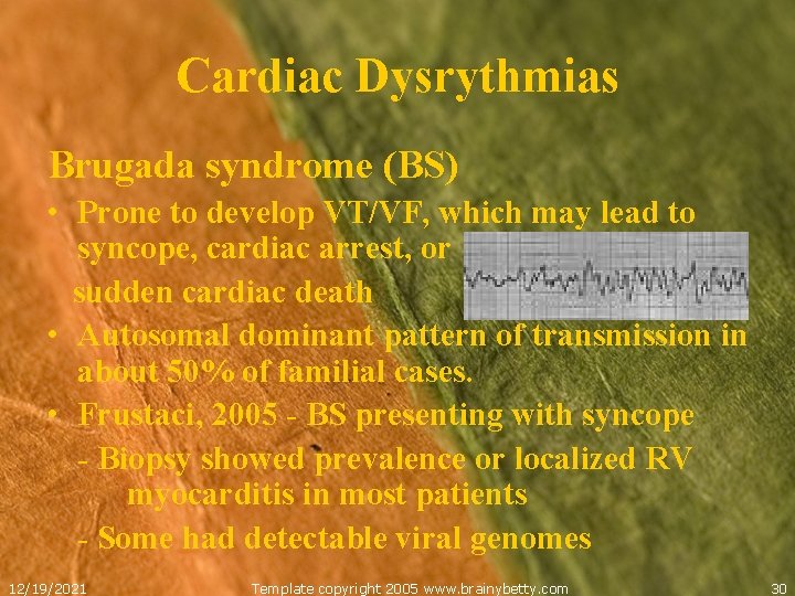 Cardiac Dysrythmias Brugada syndrome (BS) • Prone to develop VT/VF, which may lead to