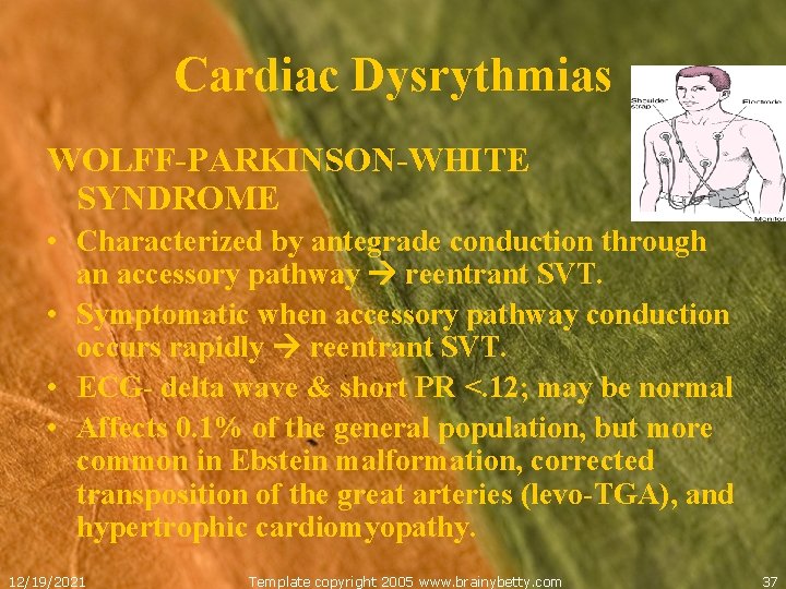 Cardiac Dysrythmias WOLFF-PARKINSON-WHITE SYNDROME • Characterized by antegrade conduction through an accessory pathway reentrant