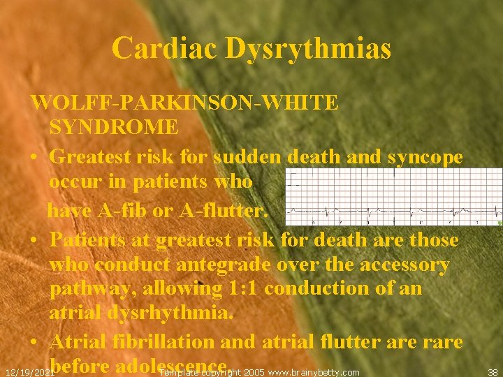 Cardiac Dysrythmias WOLFF-PARKINSON-WHITE SYNDROME • Greatest risk for sudden death and syncope occur in