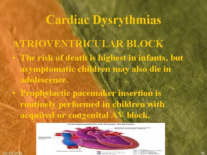Cardiac Dysrythmias ATRIOVENTRICULAR BLOCK • The risk of death is highest in infants, but