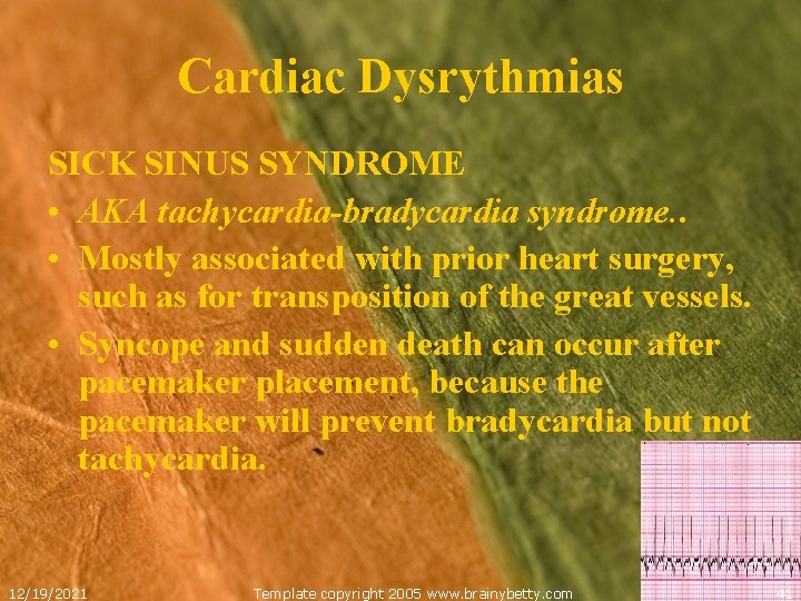 Cardiac Dysrythmias SICK SINUS SYNDROME • AKA tachycardia-bradycardia syndrome. . • Mostly associated with