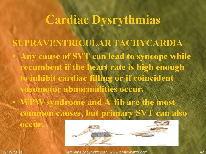 Cardiac Dysrythmias SUPRAVENTRICULAR TACHYCARDIA • Any cause of SVT can lead to syncope while