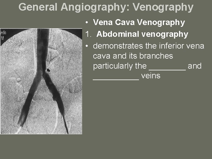 General Angiography: Venography • Vena Cava Venography 1. Abdominal venography • demonstrates the inferior