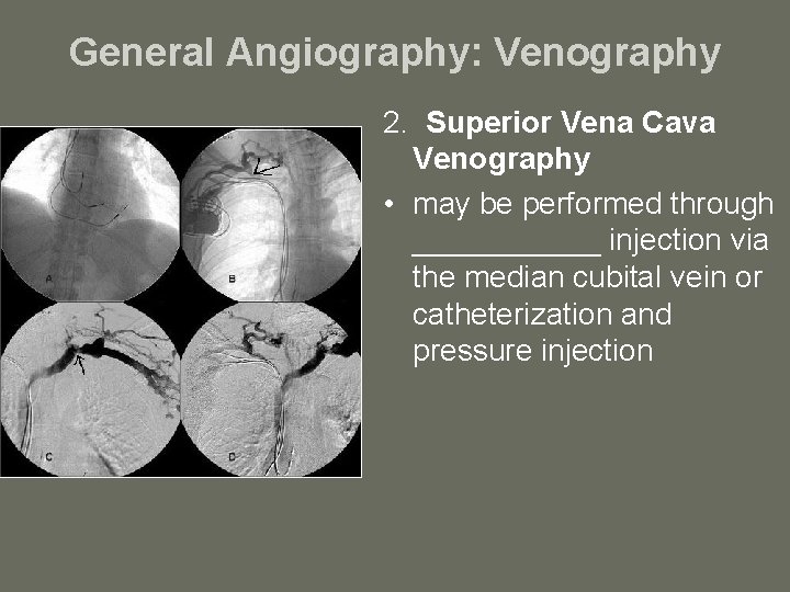 General Angiography: Venography 2. Superior Vena Cava Venography • may be performed through ______