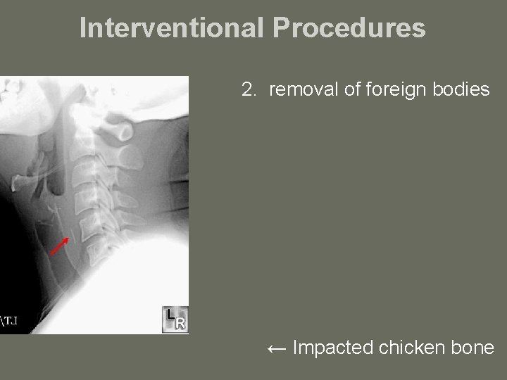 Interventional Procedures 2. removal of foreign bodies ← Impacted chicken bone 
