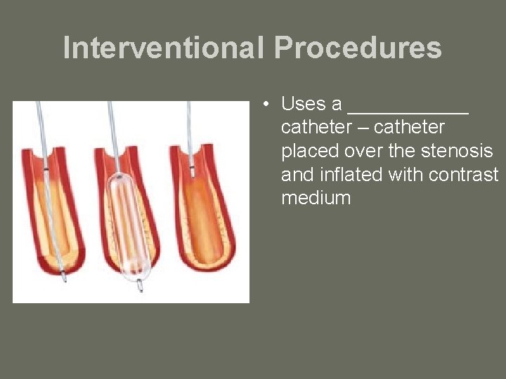 Interventional Procedures • Uses a ______ catheter – catheter placed over the stenosis and