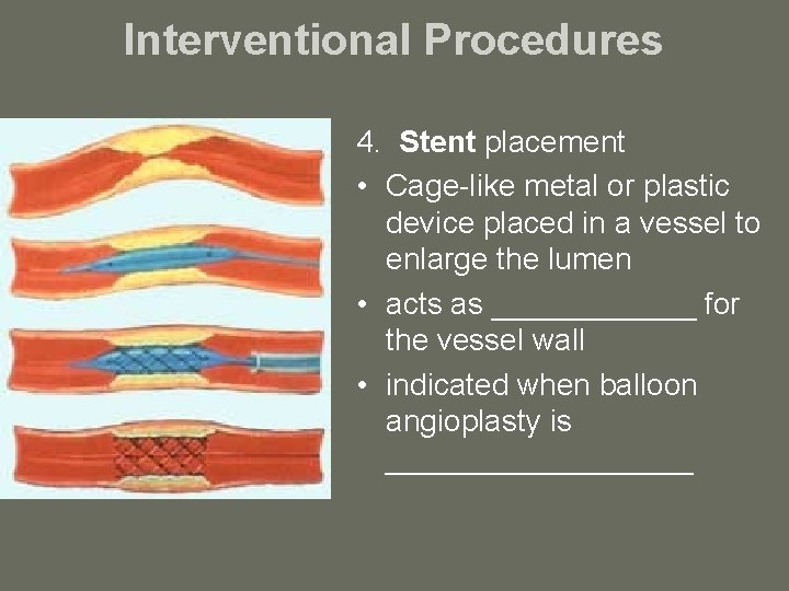 Interventional Procedures 4. Stent placement • Cage-like metal or plastic device placed in a