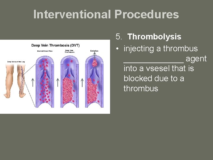 Interventional Procedures 5. Thrombolysis • injecting a thrombus _______ agent into a vsesel that