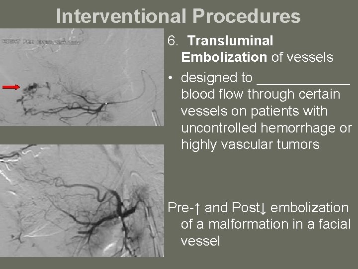 Interventional Procedures 6. Transluminal Embolization of vessels • designed to ______ blood flow through