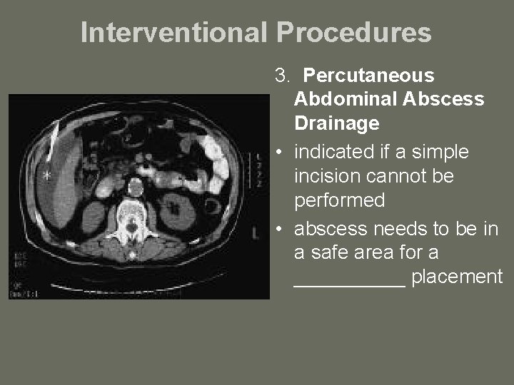 Interventional Procedures 3. Percutaneous Abdominal Abscess Drainage • indicated if a simple incision cannot