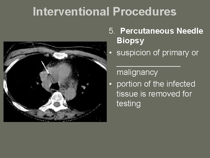 Interventional Procedures 5. Percutaneous Needle Biopsy • suspicion of primary or _______ malignancy •