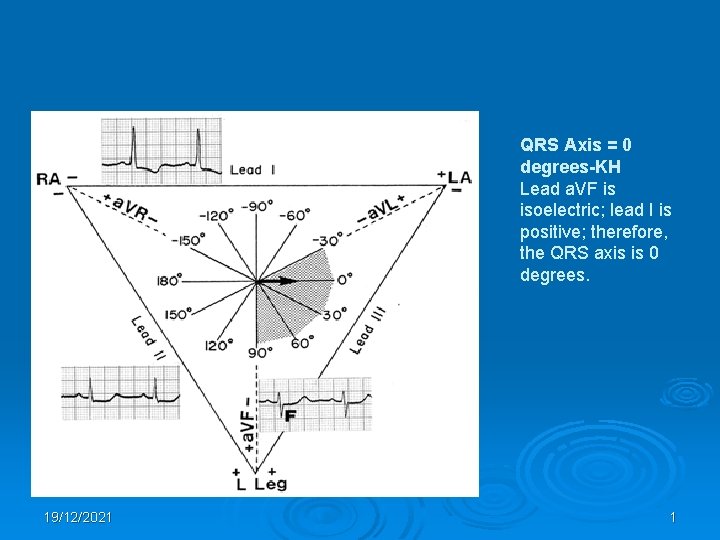 QRS Axis = 0 degrees-KH Lead a. VF is isoelectric; lead I is positive;