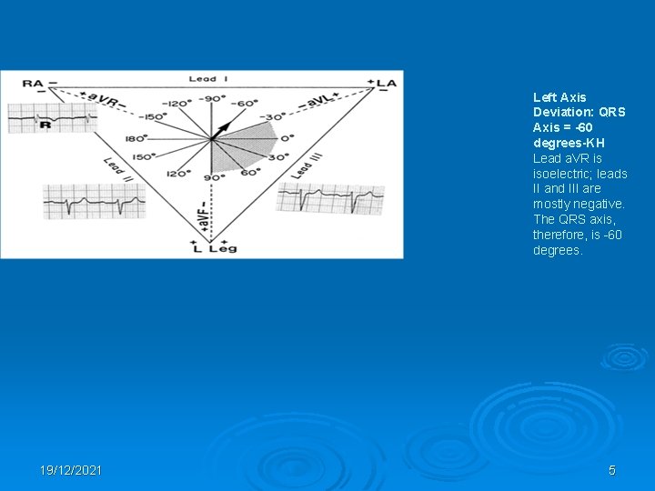 Left Axis Deviation: QRS Axis = -60 degrees-KH Lead a. VR is isoelectric; leads