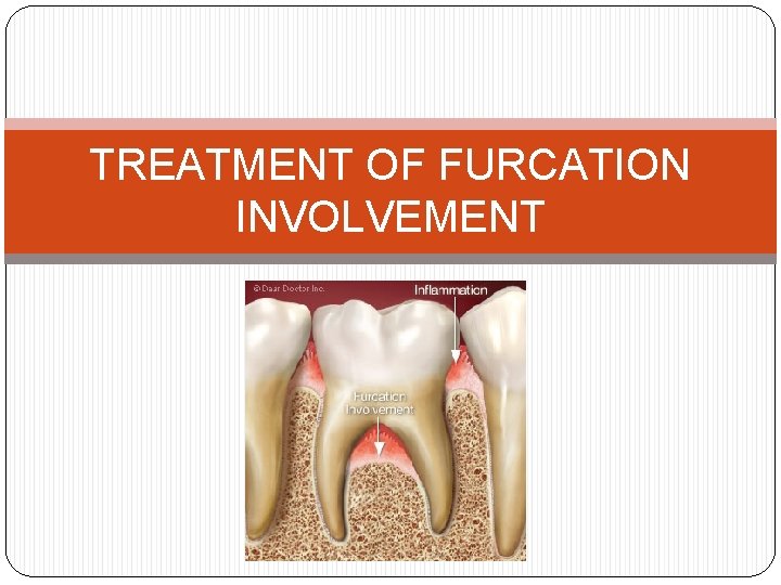 TREATMENT OF FURCATION INVOLVEMENT 