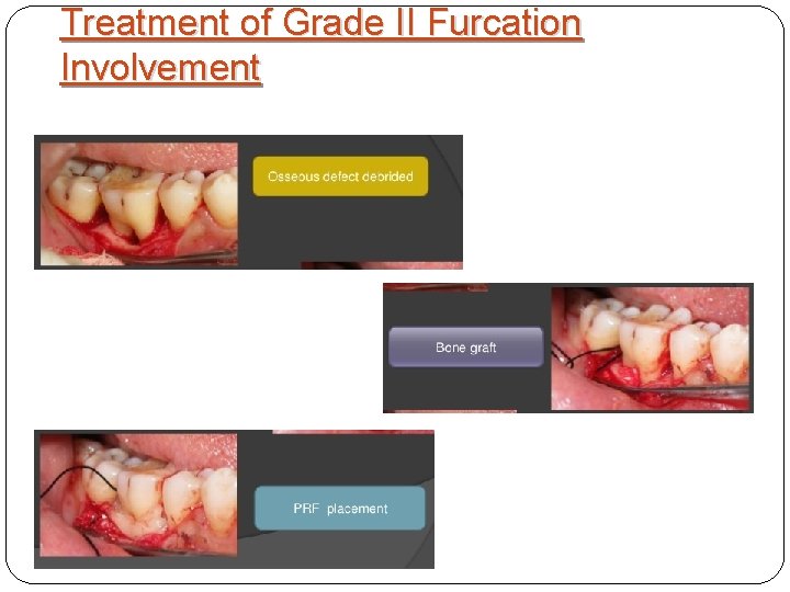 Treatment of Grade II Furcation Involvement 