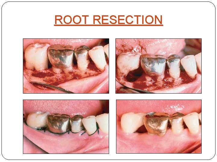 ROOT RESECTION 