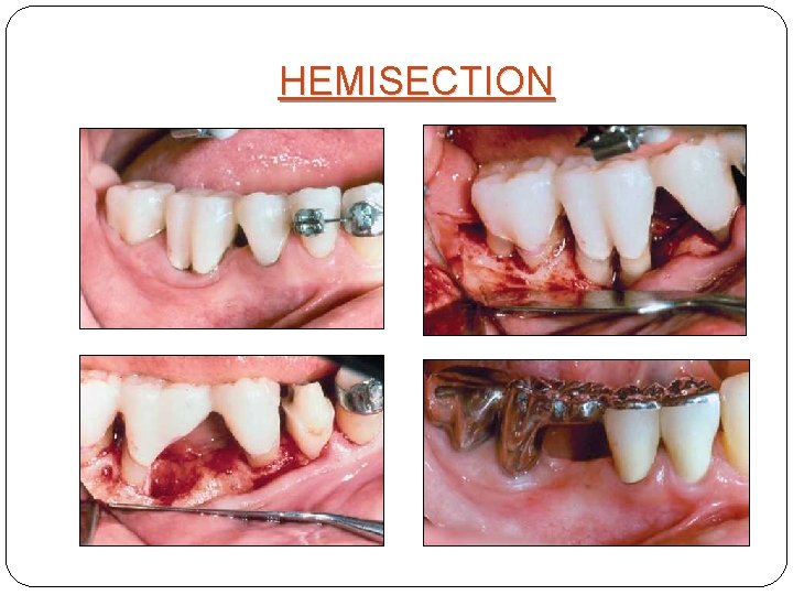 HEMISECTION 