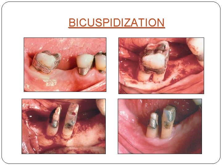 BICUSPIDIZATION 