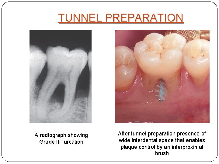 TUNNEL PREPARATION A radiograph showing Grade III furcation After tunnel preparation presence of wide