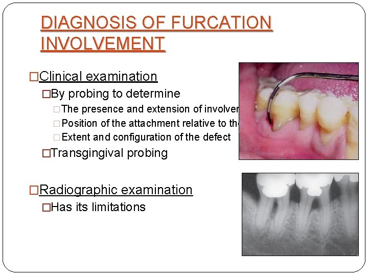 DIAGNOSIS OF FURCATION INVOLVEMENT �Clinical examination �By probing to determine �The presence and extension