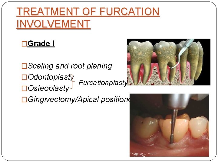 TREATMENT OF FURCATION INVOLVEMENT �Grade I �Scaling and root planing �Odontoplasty �Osteoplasty Furcationplasty �Gingivectomy/Apical