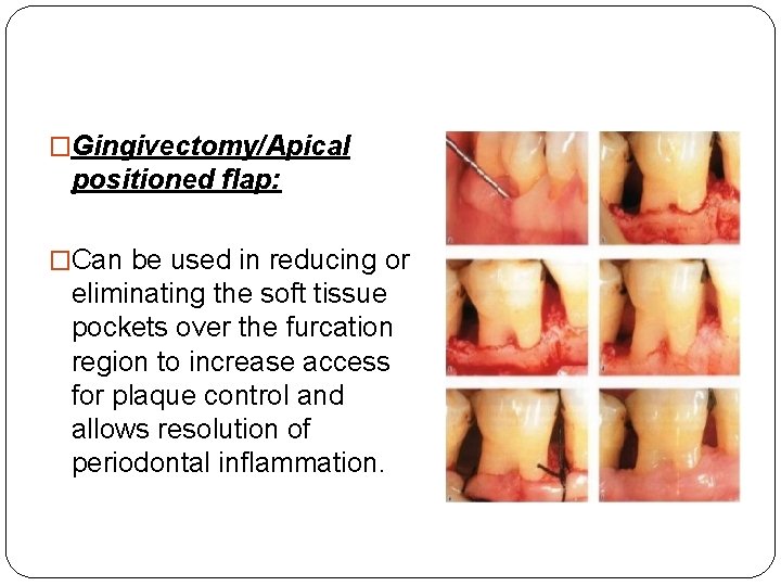 �Gingivectomy/Apical positioned flap: �Can be used in reducing or eliminating the soft tissue pockets