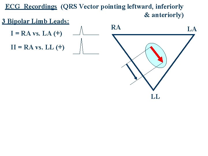 ECG Recordings (QRS Vector pointing leftward, inferiorly & anteriorly) 3 Bipolar Limb Leads: RA