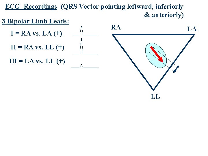 ECG Recordings (QRS Vector pointing leftward, inferiorly & anteriorly) 3 Bipolar Limb Leads: RA