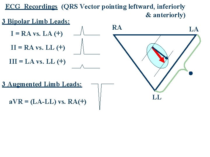 ECG Recordings (QRS Vector pointing leftward, inferiorly & anteriorly) 3 Bipolar Limb Leads: RA