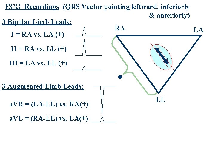 ECG Recordings (QRS Vector pointing leftward, inferiorly & anteriorly) 3 Bipolar Limb Leads: RA