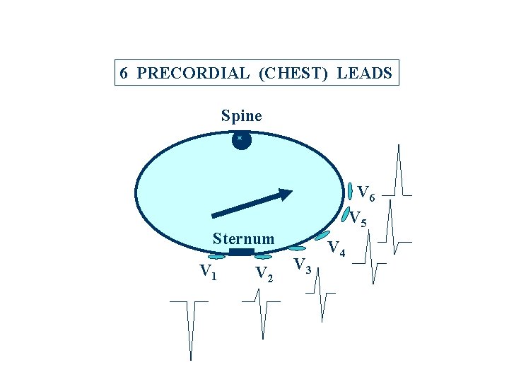 6 PRECORDIAL (CHEST) LEADS Spine V 6 V 5 Sternum V 1 V 2