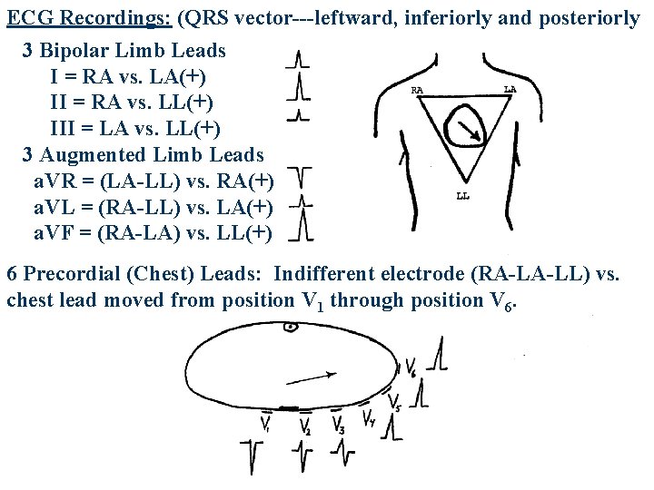 ECG Recordings: (QRS vector---leftward, inferiorly and posteriorly 3 Bipolar Limb Leads I = RA