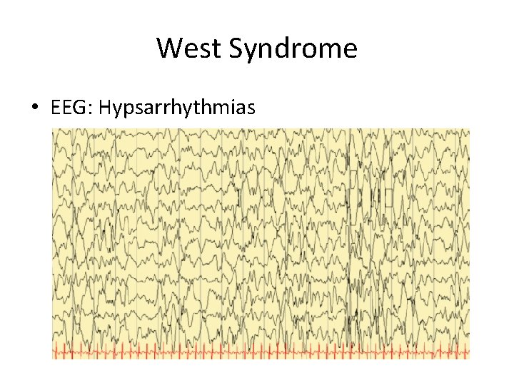 West Syndrome • EEG: Hypsarrhythmias 