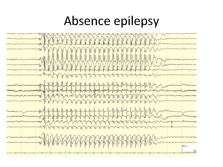 Absence epilepsy 