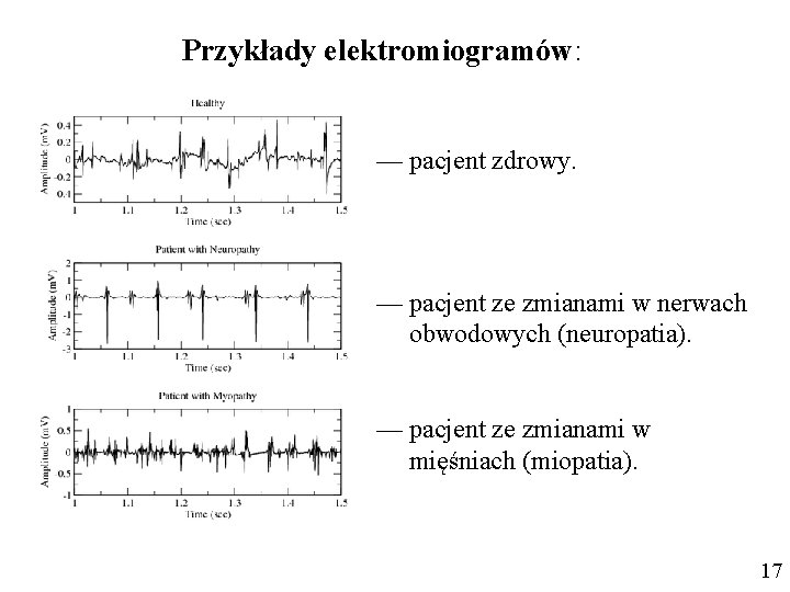 Przykłady elektromiogramów: — pacjent zdrowy. — pacjent ze zmianami w nerwach obwodowych (neuropatia). —