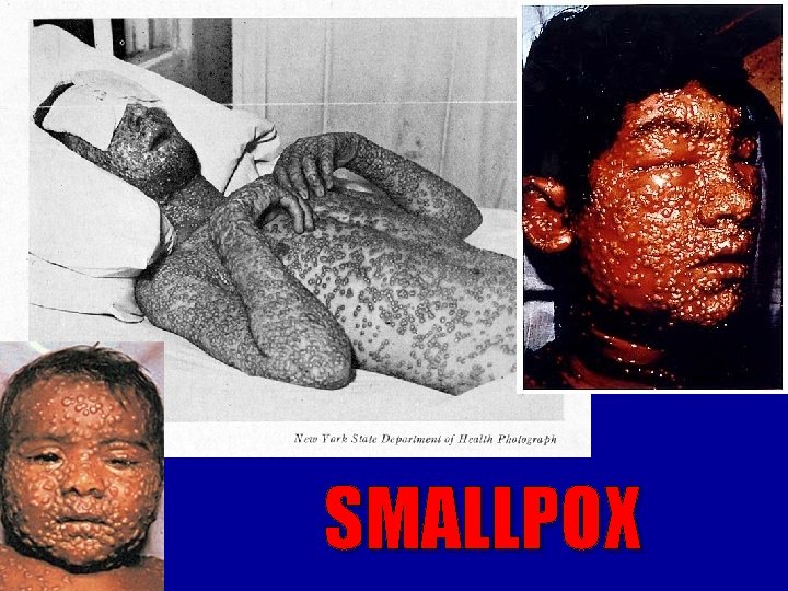 SMALLPOX SMALLPOX