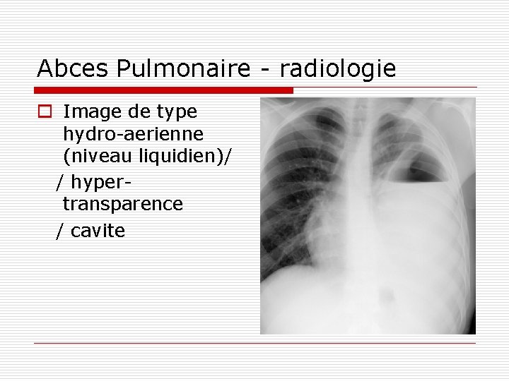 Abces Pulmonaire - radiologie o Image de type hydro-aerienne (niveau liquidien)/ / hypertransparence /