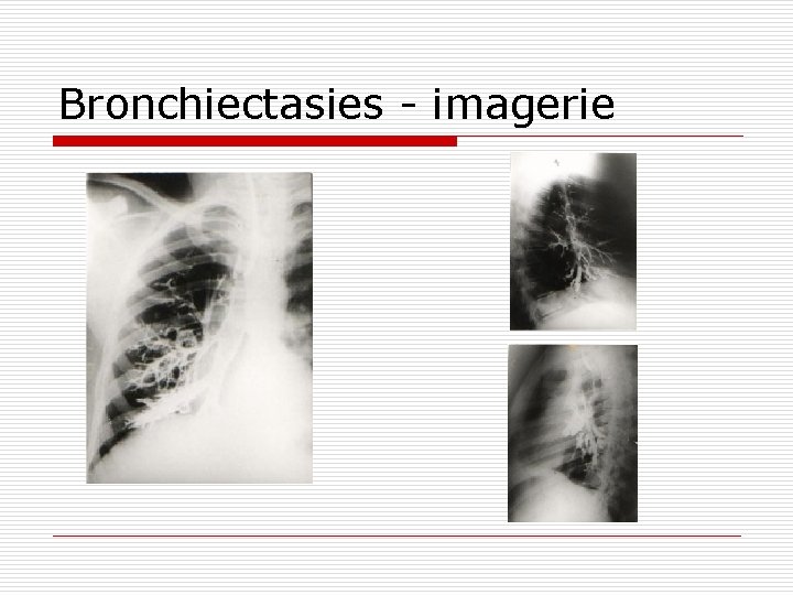 Bronchiectasies - imagerie 